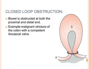 Intestinal obstruction | PPTX