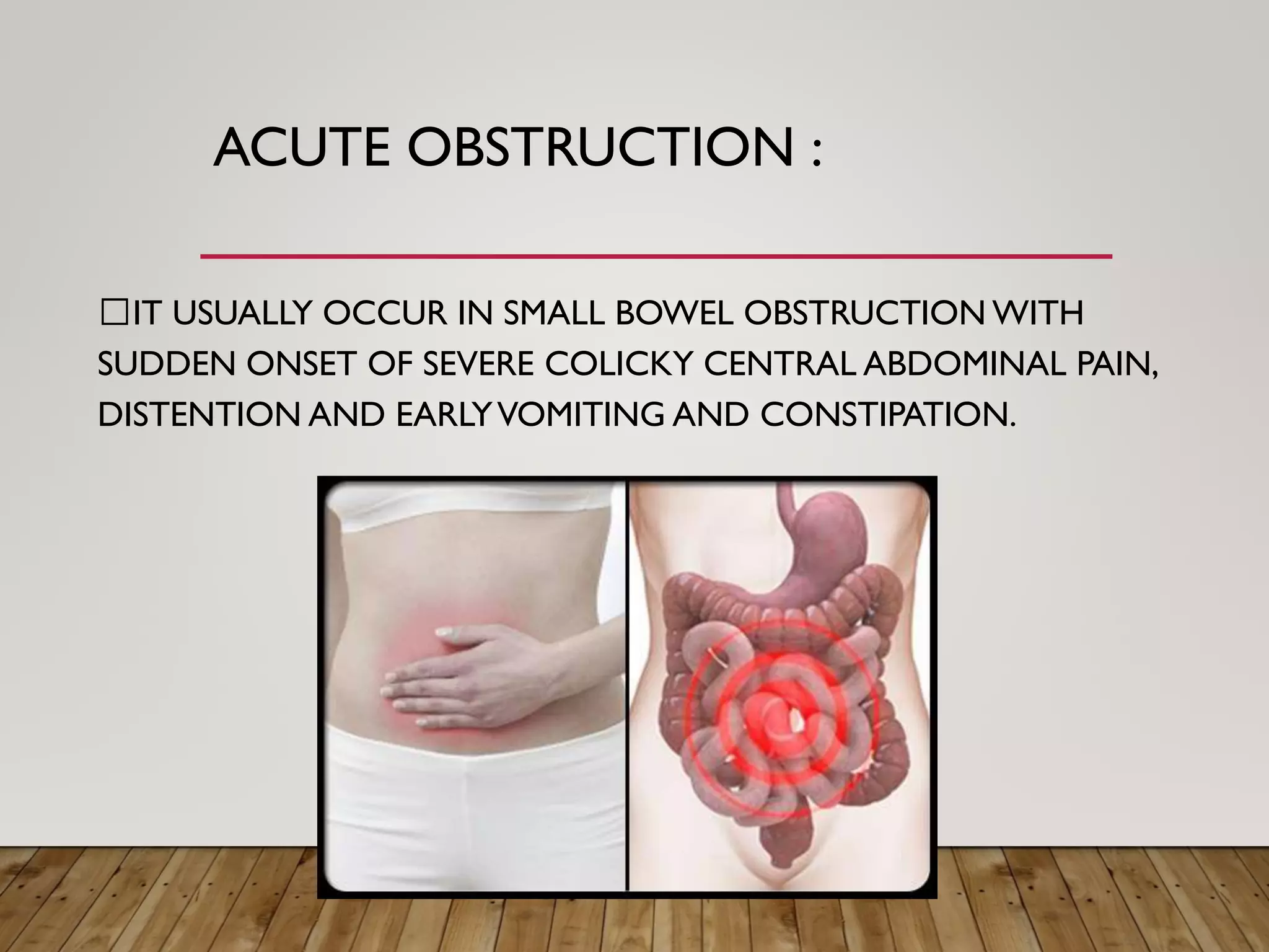 Intestinal obstruction | PDF