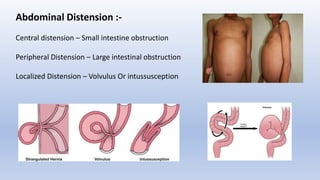 Abdominal Distension :-
Central distension – Small intestine obstruction
Peripheral Distension – Large intestinal obstruction
Localized Distension – Volvulus Or intussusception
 