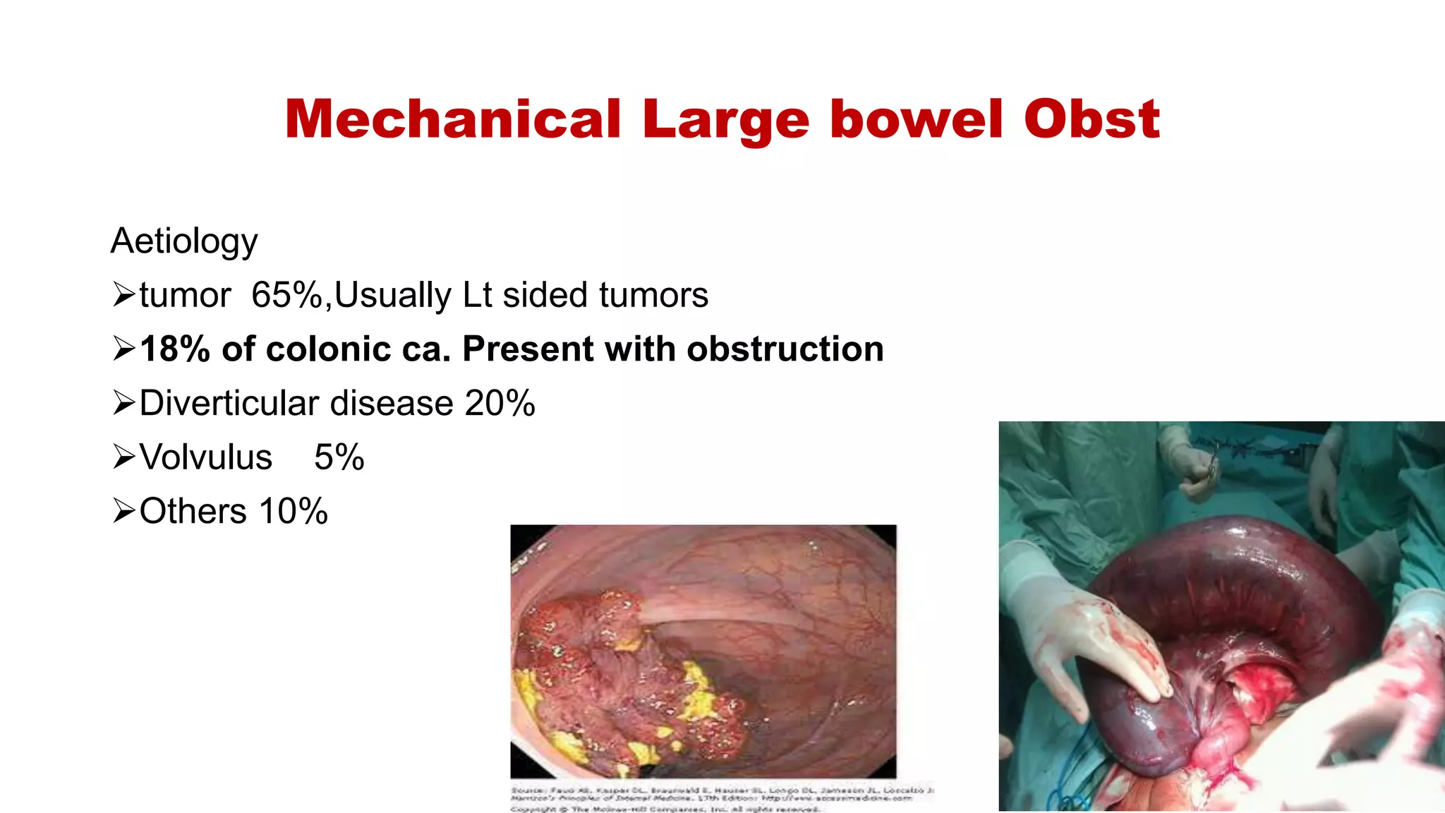 Mechanical Large bowel Obst
Aetiology
tumor 65%,Usually Lt sided tumors
18% of colonic ca. Present with obstruction
Diverticular disease 20%
Volvulus 5%
Others 10%
 