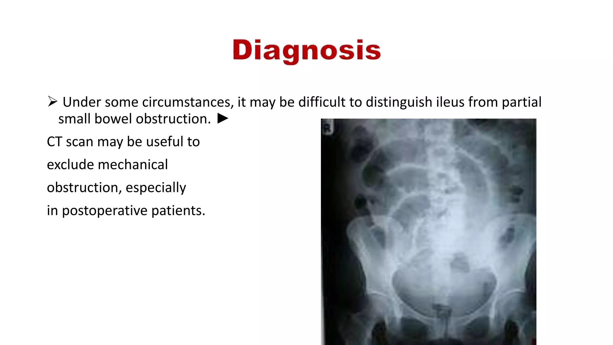  Under some circumstances, it may be difficult to distinguish ileus from partial
small bowel obstruction. ►
CT scan may be useful to
exclude mechanical
obstruction, especially
in postoperative patients.
 