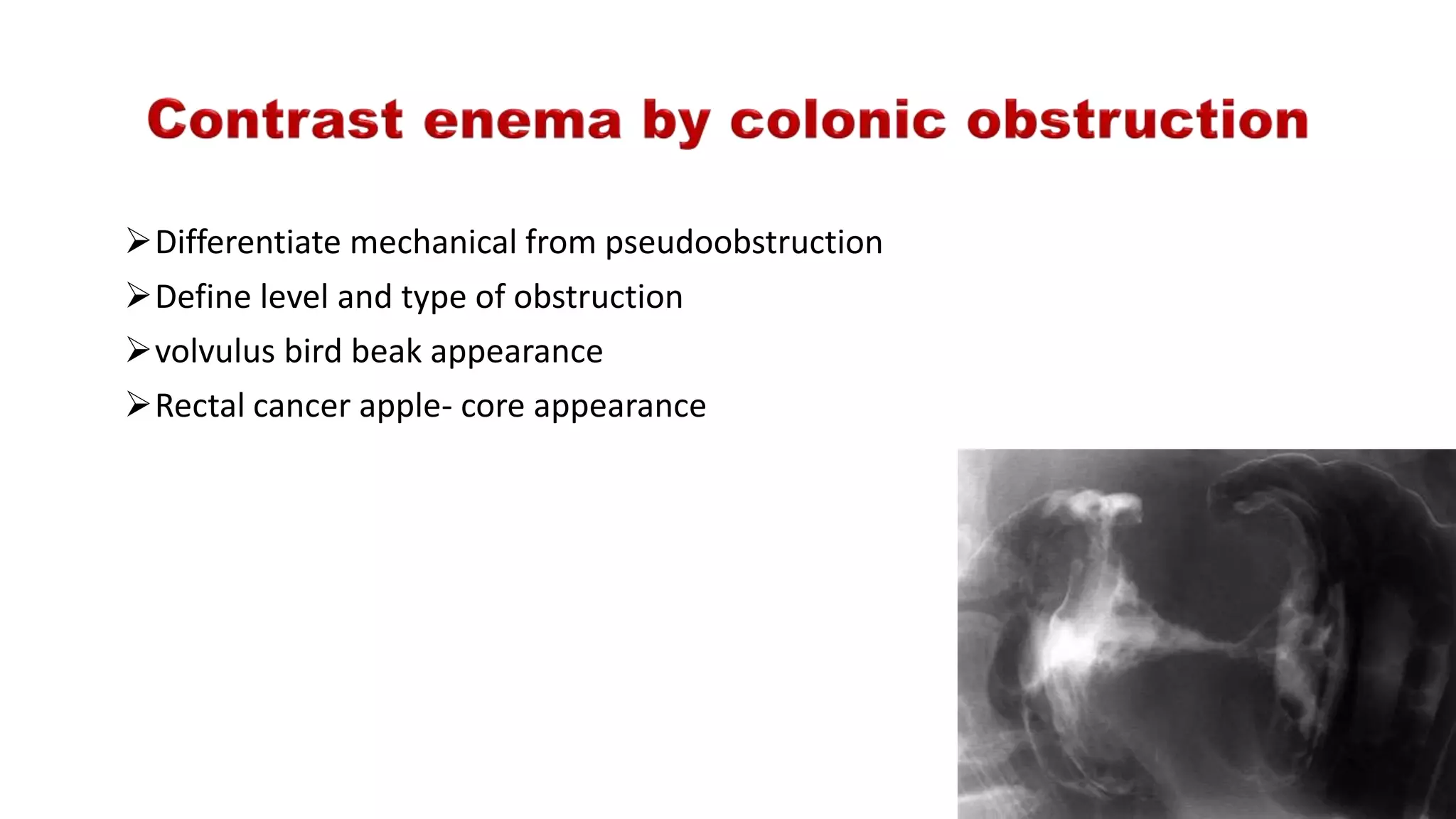 Differentiate mechanical from pseudoobstruction
Define level and type of obstruction
volvulus bird beak appearance
Rectal cancer apple- core appearance
 