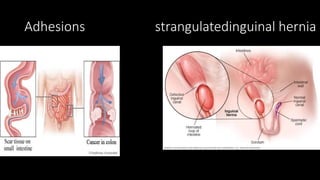 Adhesions strangulatedinguinal hernia
 