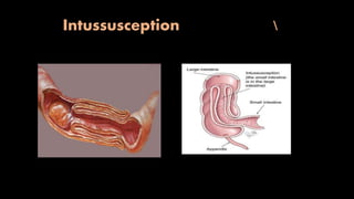 Intussusception 
 