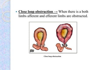 Obstruction Left Intestinal obstruction | PPTX