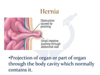 Hernia
•Projection of organ or part of organ
through the body cavity which normally
contains it.
 