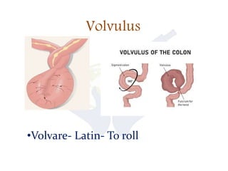 Volvulus
•Volvare- Latin- To roll
 