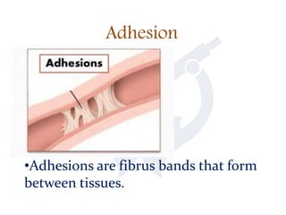 Adhesion
•Adhesions are fibrus bands that form
between tissues.
 