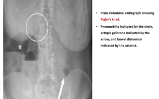 • Plain abdominal radiograph showing
Rigler’s triad.
• Pneumobilia indicated by the circle,
ectopic gallstone indicated by the
arrow, and bowel distension
indicated by the asterisk.
 