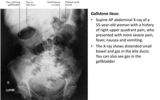 Gallstone ileus:
• Supine AP abdominal X-ray of a
55-year-old woman with a history
of right upper quadrant pain, who
presented with more severe pain,
fever, nausea and vomiting.
• The X-ray shows distended small
bowel and gas in the bile ducts.
You can also see gas in the
gallbladder
 