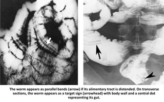 The worm appears as parallel bands (arrow) if its alimentary tract is distended. On transverse
sections, the worm appears as a target sign (arrowhead) with body wall and a central dot
representing its gut.
 