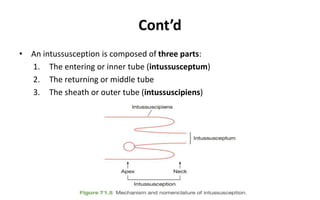 Cont’d
• An intussusception is composed of three parts:
1. The entering or inner tube (intussusceptum)
2. The returning or middle tube
3. The sheath or outer tube (intussuscipiens)
 
