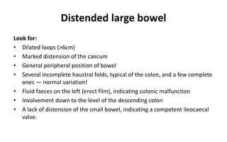 Distended large bowel
Look for:
• Dilated loops (>6cm)
• Marked distension of the caecum
• General peripheral position of bowel
• Several incomplete haustral folds, typical of the colon, and a few complete
ones — normal variation!
• Fluid faeces on the left (erect film), indicating colonic malfunction
• Involvement down to the level of the descending colon
• A lack of distension of the small bowel, indicating a competent ileocaecal
valve.
 