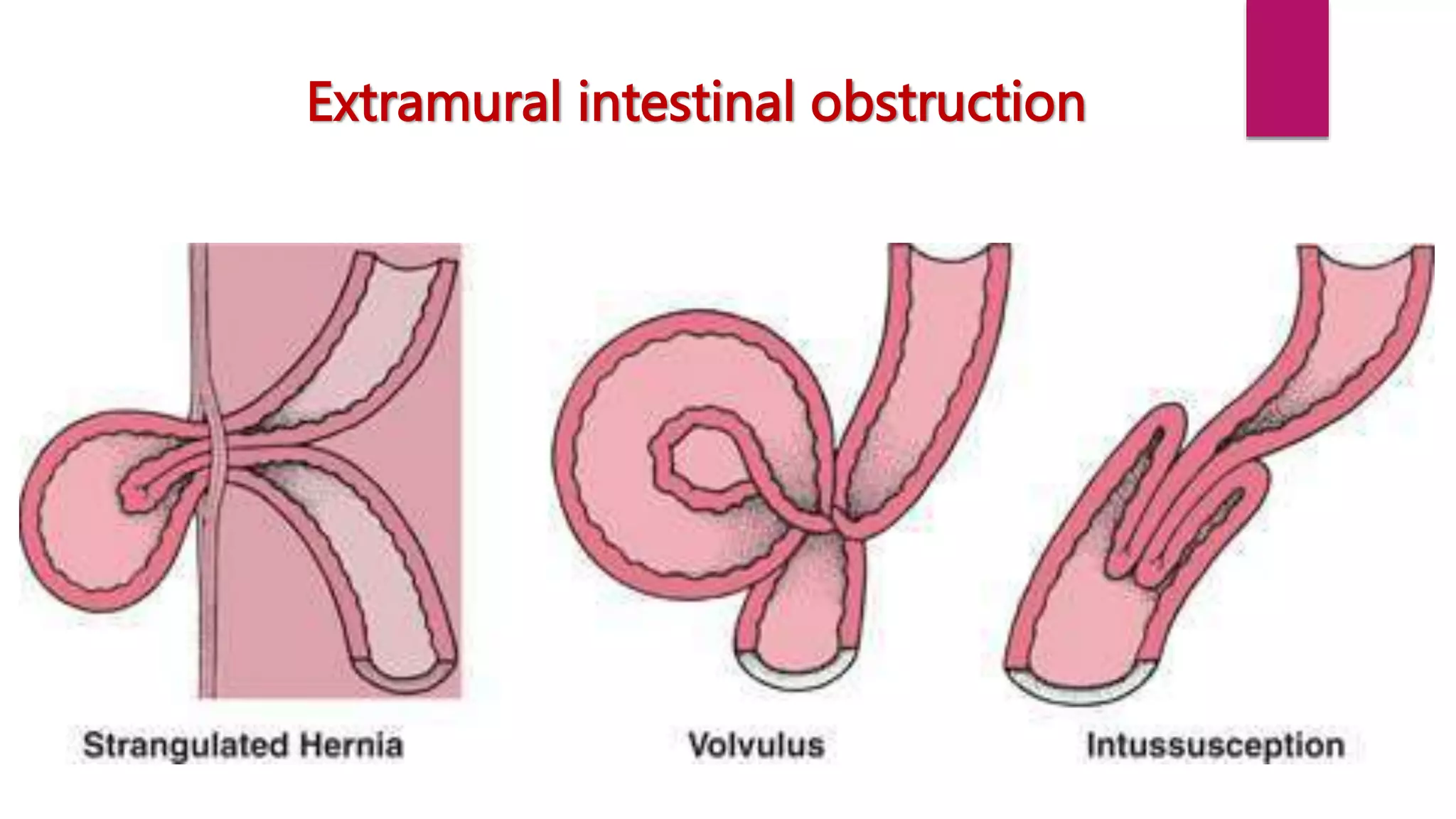 Patho Intestinal Obstruction intestinal obstruction.pptx