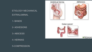 ETIOLOGY MECHANICAL
EXTRALUMINAL
1- BANDS
2- ADHESIONS
3- ABSCESS
4- HERNIAS
5-COMPRESSION
 