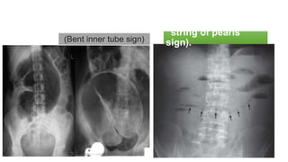 intestinal obstruction.pptx by Dr shaheed Alaamry | PPTX