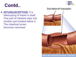 INTESTINAL OBSTRUCTION and its management .ppt