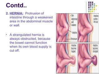 INTESTINAL OBSTRUCTION and its management .ppt