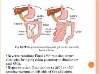 Intestinal Obstruction-FINAL.pptx finals | PPTX