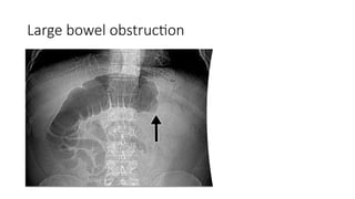 Large bowel obstruction
 