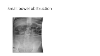 Small bowel obstruction
 