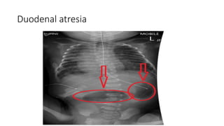 Duodenal atresia
 