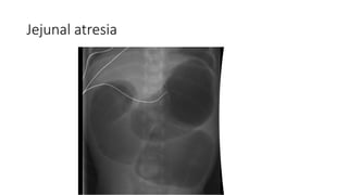 Jejunal atresia
 