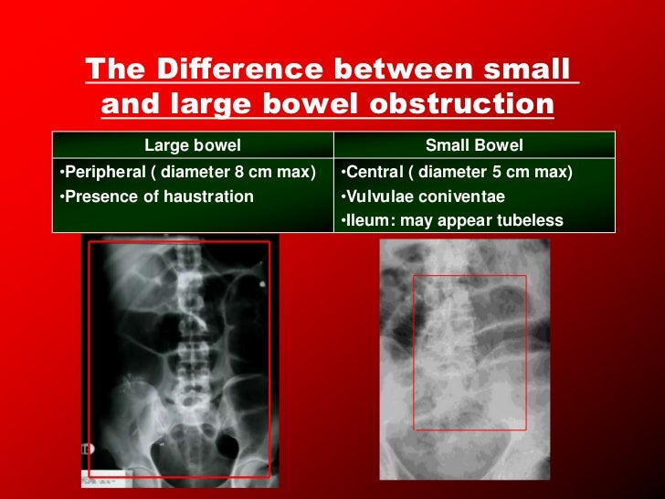 Intestinal obstruction2
