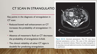 Comprehensive Overview of Intestinal Obstruction: Classification ...