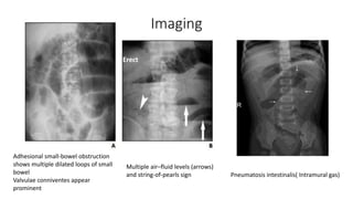 Intestinal Obstruction | PPTX