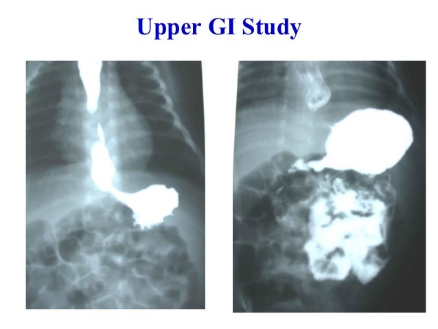 ลำไส้อุดตันในเด็ก (Intestinal obstruction in children)