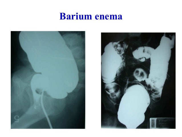ลำไส้อุดตันในเด็ก (Intestinal obstruction in children)