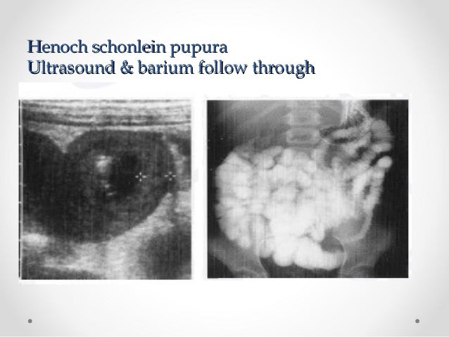 Bowel obstruction in children