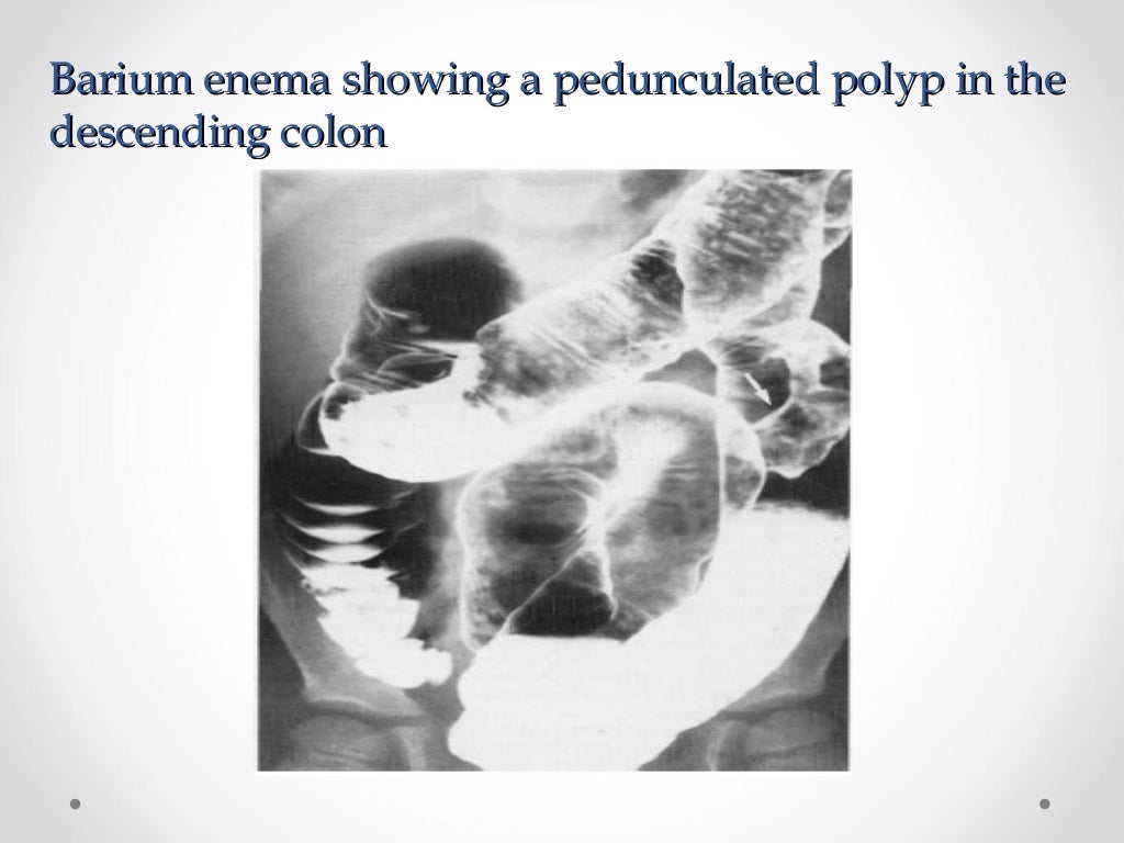 Intestinal obstruction in children