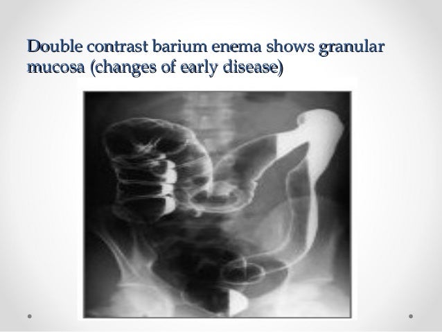 Intestinal obstruction in children