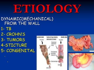 ETIOLOGY
DYNAMIC(MECHANICAL)
FROM THE WALL
1- TB
2- CROHN’S
3- TUMORS
4-STICTURE
5- CONGENITAL ………
.
.
 