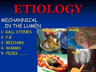 ETIOLOGY
MECHANNICAL
IN THE LUMEN
1- GALL STONES
2- F.B
3- BEZOARS
4- WARMS
5- FECES ………..
GALL
STONES
BEZOARS WARMs
FECES
 