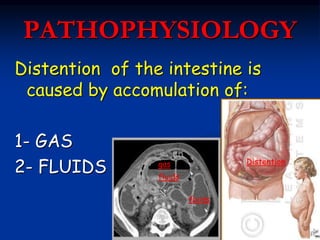 PATHOPHYSIOLOGY
Distention of the intestine is
caused by accomulation of:
1- GAS
2- FLUIDS gas
fluids
Distention
fluids
 
