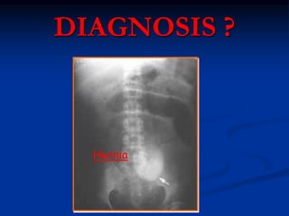 DIAGNOSIS ?
Hernia
 