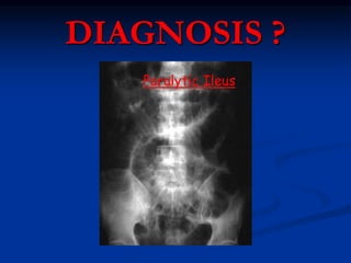 DIAGNOSIS ?
Paralytic Ileus
 