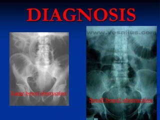 DIAGNOSIS
Small bowel
obstruction
Large bowel
obstruction
 