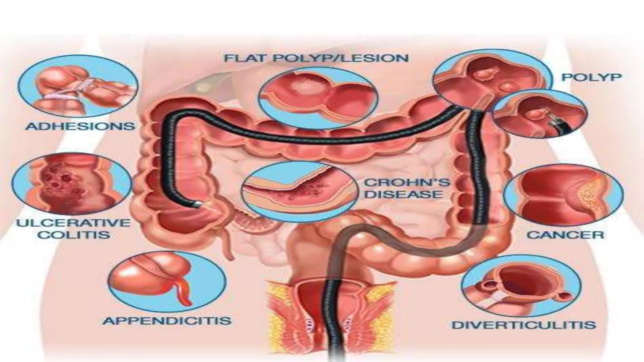 Intestinal obstruction, BOWEL OBSTRUCTION | PPTX