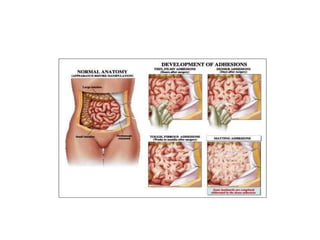 INTESTINAL_OBSTRUCTION_PPT.pptx