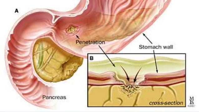 Intestinal Perforation intestinal-perforation