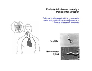 Periodontal disease is really a 
Periodontal infection 
Science is showing that the gums are a 
major entry point for microorganisms to 
invade the rest of the body. 
Candida 
Helicobacter 
Pylori 
 