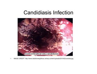 Candidiasis Infection 
• IMAGE CREDIT: http://www.dietsforweightloss.net/wp-content/uploads/2010/02/candida.jpg 
 