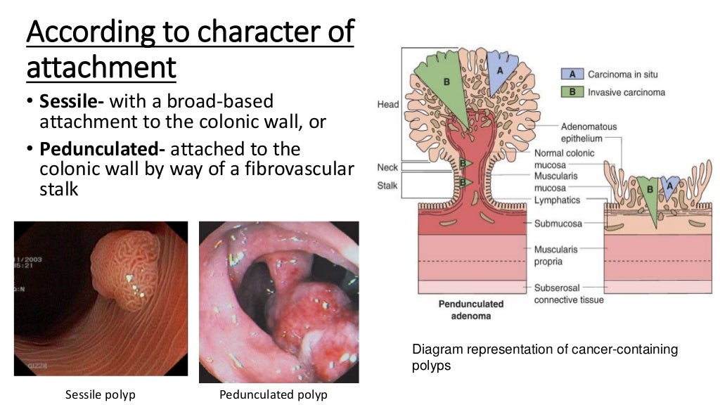 Intestinal polyps