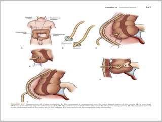 Stoma Inversion Intestinal stoma( COLOSTOMY) | PPTX