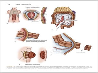 Intestinal stoma( COLOSTOMY) | PPTX
