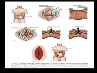 Intestinal stoma( COLOSTOMY) | PPTX